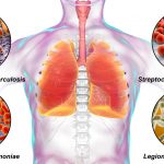 What Are the Methods of Legionnaires Disease Disinfections?